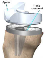 tibial components,knee replacement india,knee replacement india