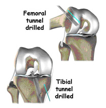 femoral tunnel drilled,acl injury,acl reconstruction india,acl reconstruction best india,acl reconstructionbest doctors in india,acl reconstruction best surgeon in india,acl reconstructionbest surgery in india,acl reconstruction best treatment in  india,acl reconstruction in south  india,acl reconstruction north  india,acl reconstruction  east india,acl reconstruction west india,acl reconstruction best in  india,acl reconstruction best surgery in india,acl reconstruction cost-effective in  india,acl reconstruction best doctors in india,acl reconstruction india,acl reconstruction india,acl reconstruction india,acl reconstruction now in india,acl reconstruction india