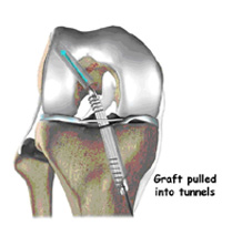 surgical procedure,acl injury,acl reconstruction india,acl reconstruction best india,acl reconstructionbest doctors in india,acl reconstruction best surgeon in india,acl reconstructionbest surgery in india,acl reconstruction best treatment in  india,acl reconstruction in south  india,acl reconstruction north  india,acl reconstruction  east india,acl reconstruction west india,acl reconstruction best in  india,acl reconstruction best surgery in india,acl reconstruction cost-effective in  india,acl reconstruction best doctors in india,acl reconstruction india,acl reconstruction india,acl reconstruction india,acl reconstruction now in india,acl reconstruction india