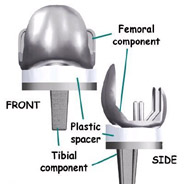 components,knee replacement, knee replacement surgeon, knee replacement surgeon in india,knee replacement india